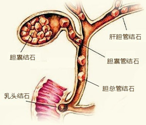 了解什么是胆囊结石呢？(图3)