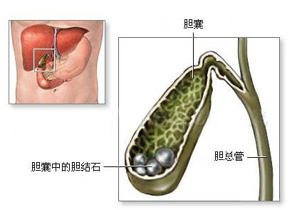 治疗胆结石有比切胆还好的妙招！(图1)
